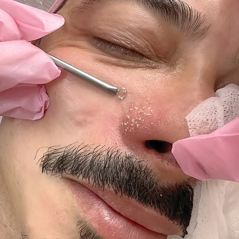 Resultado de Limpeza de pele na Rosa Beauty Space